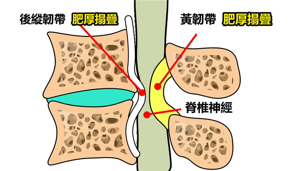 Spinal Stenosis